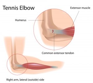 Tennis elbow, Golfer's elbow, Lateral epicondylitis, Osteopath, Valued Health Osteopathy, Osteopath Bentleigh East, Osteopath Bentleigh