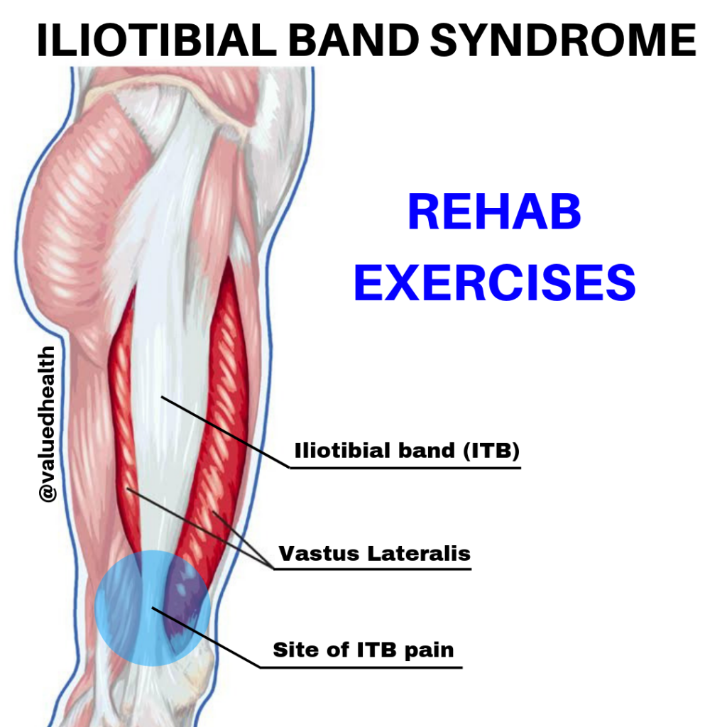 Iliotibial Band Syndrome Symptoms Diagnosis Treatment - vrogue.co