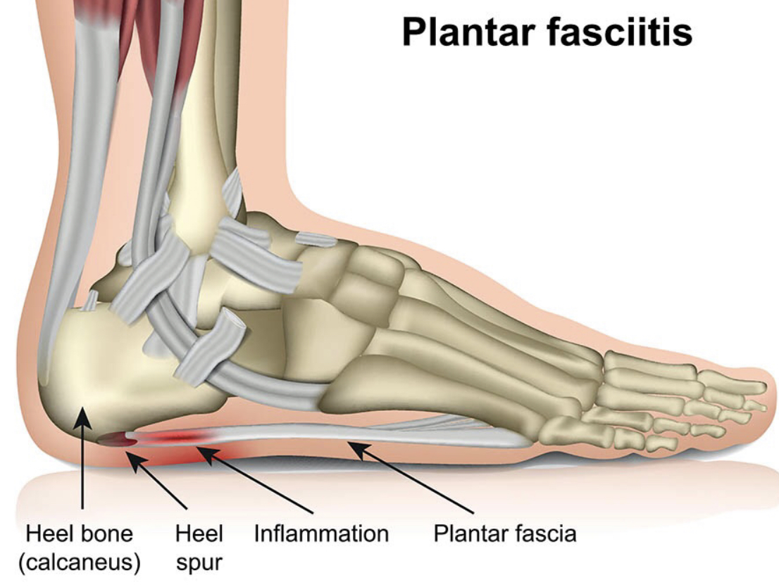 Plantar Fasciitis is a common foot complaint treated by Osteopaths